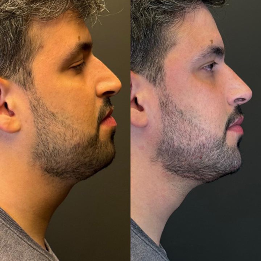 Resultado - Harmonização Orofacial