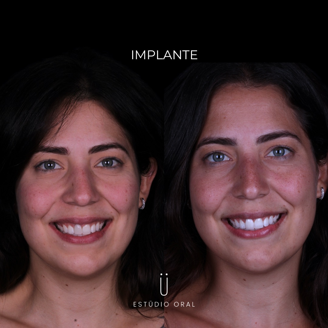 Resultado - Implante Dentário